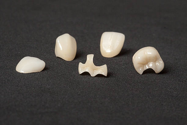 Inlays / Onlays