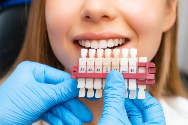 Veneers