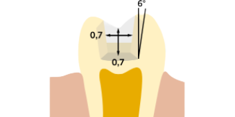 Posterior Crown preparation demonstration